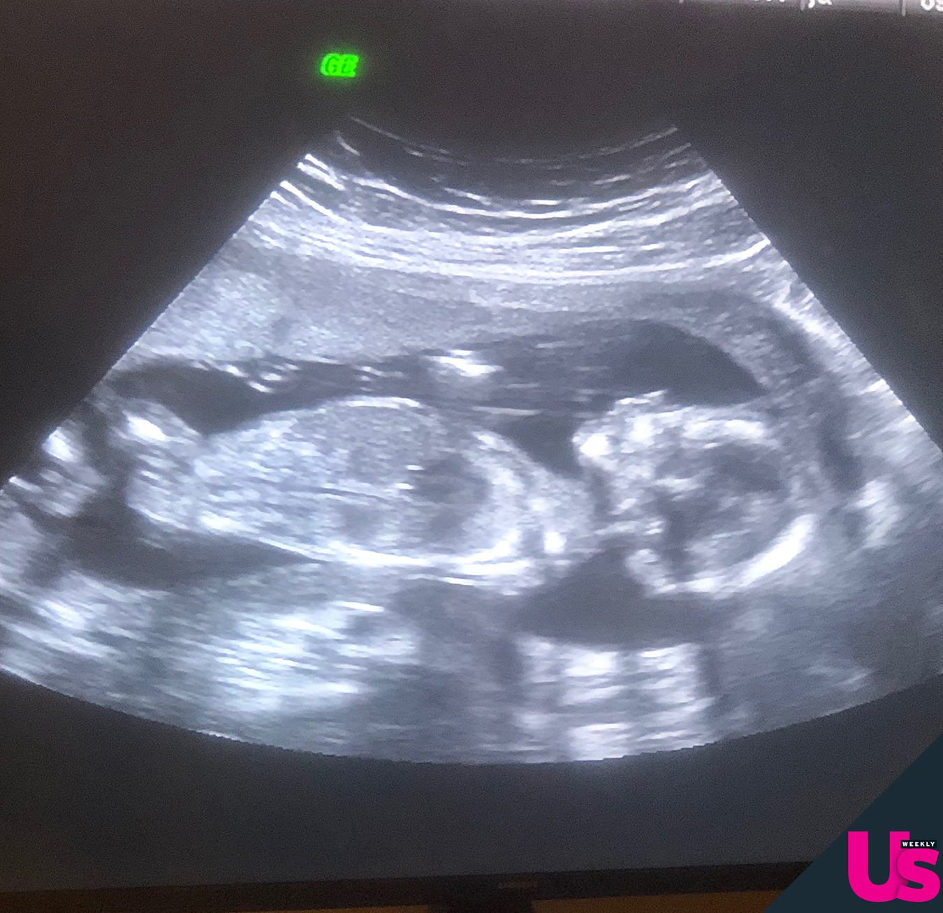 Catelynn-Lowell-Tyler-Baltierra-ultrasound
