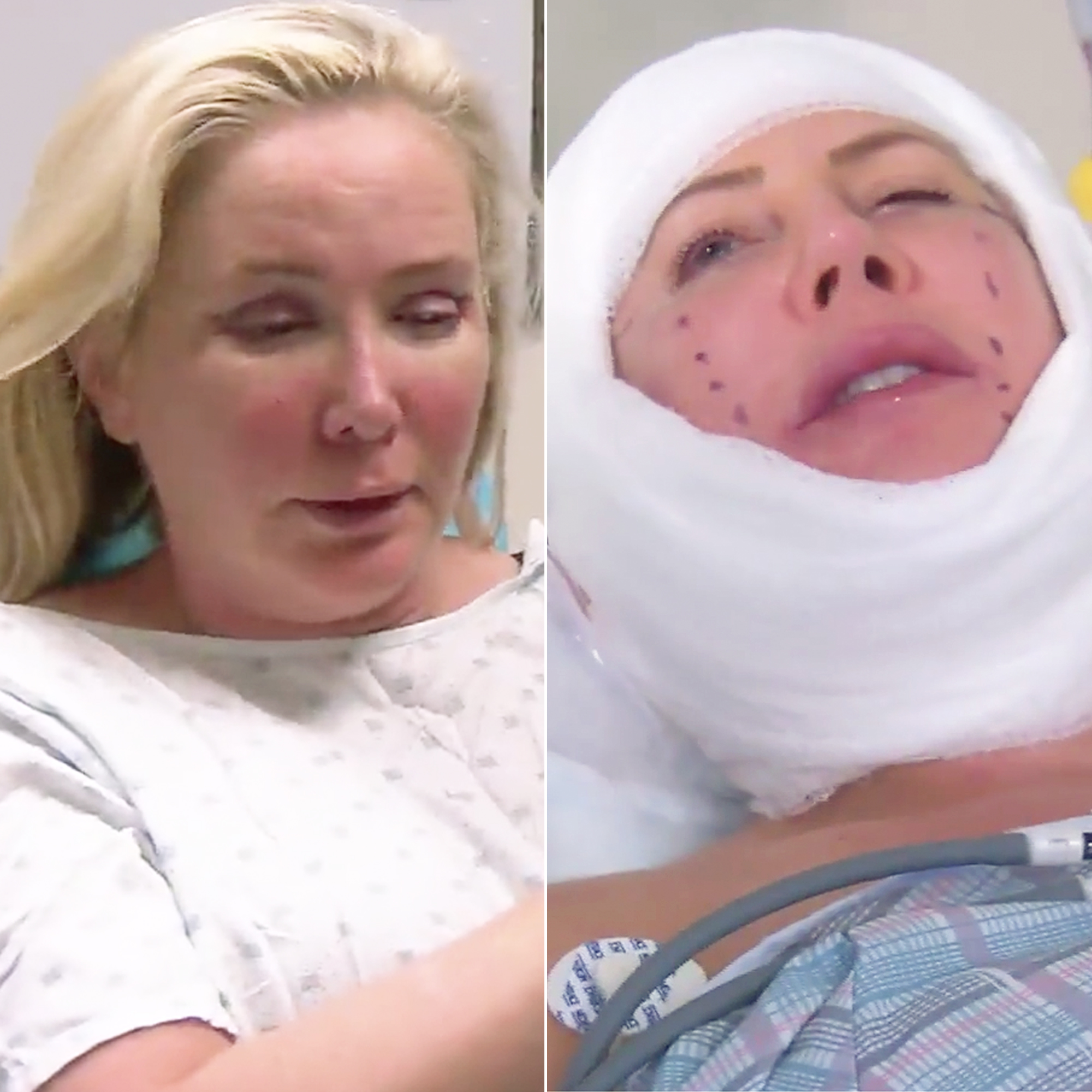 Shannon Beador Vicki Gunvalson Surgery