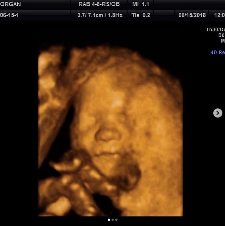 Bode Miller&rsquo;s Wife Shares Ultrasound