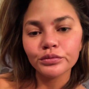 Chrissy Teigen Is Just Like Us, Has #SkinProbems