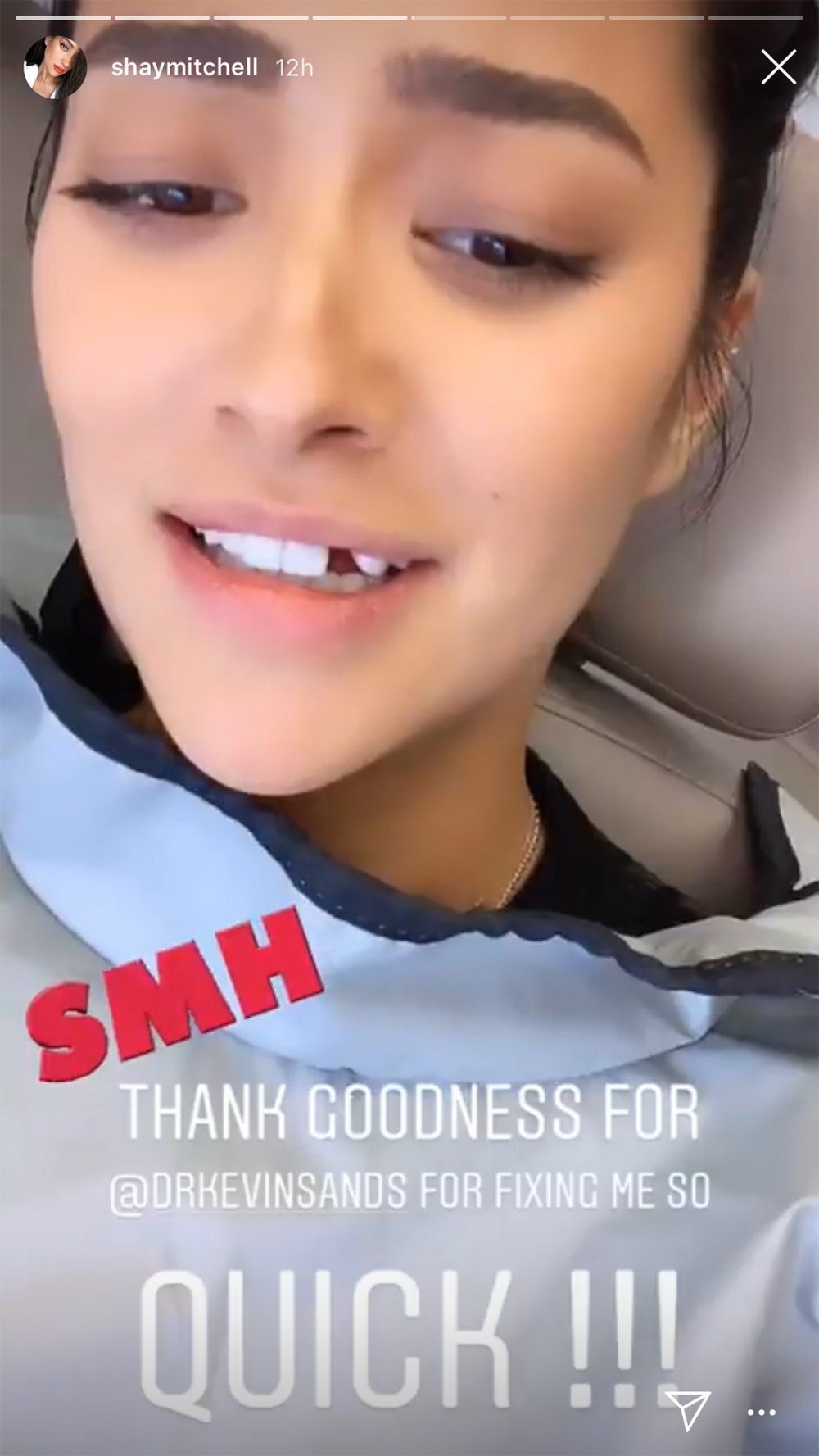 Shay Mitchell Loses a Tooth