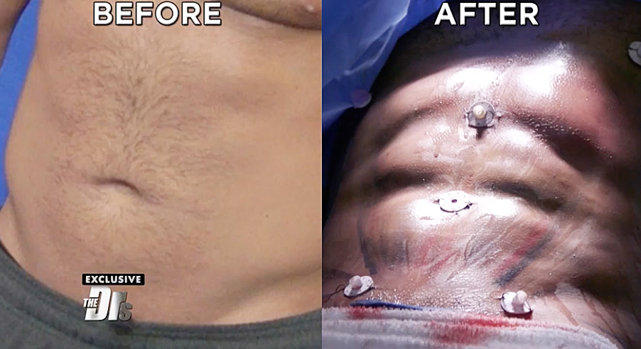 Ronnie-Ortiz-Magro-Liposuction-1.jpg