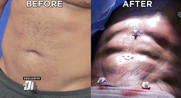 Ronnie Ortiz Magro Liposuction