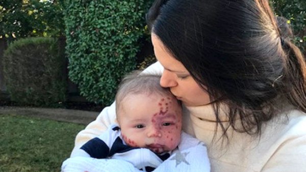 Bachelor Shawntel Newton Son Birthmark Mistakenly Deemed Measles