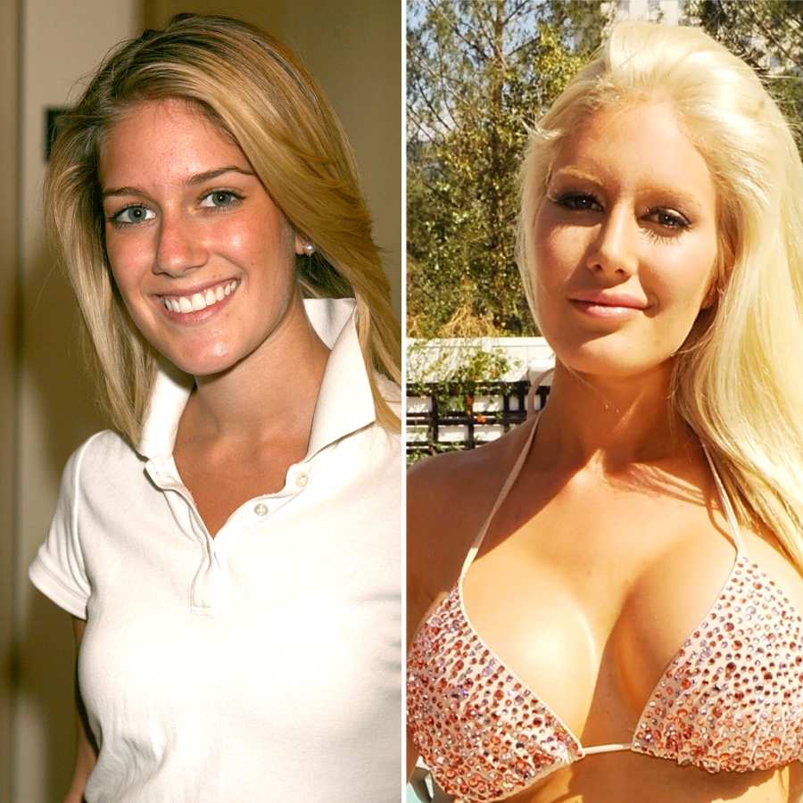 plastic surgery celebs before after
