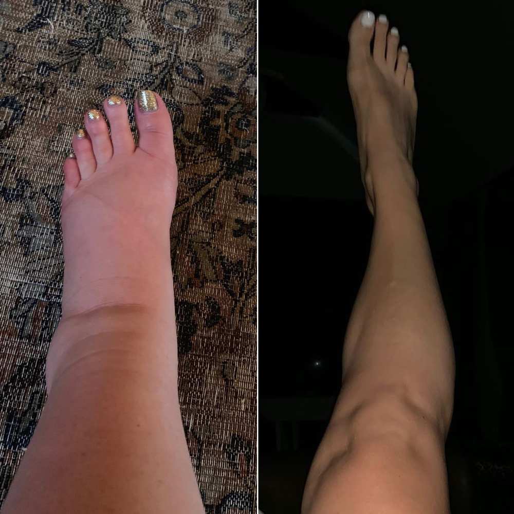Jessica Simpson Postpartum Ankles After Swollen Pregnancy Feet