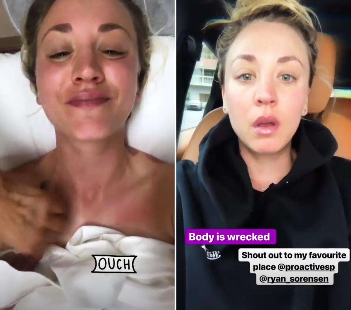 Kaley Cuoco Shares Crazy Post Workout Cupping Therapy Video Aol Lifestyle