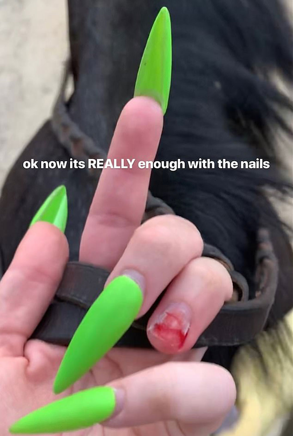 Billie Eilish Nails Accident Instagram Story