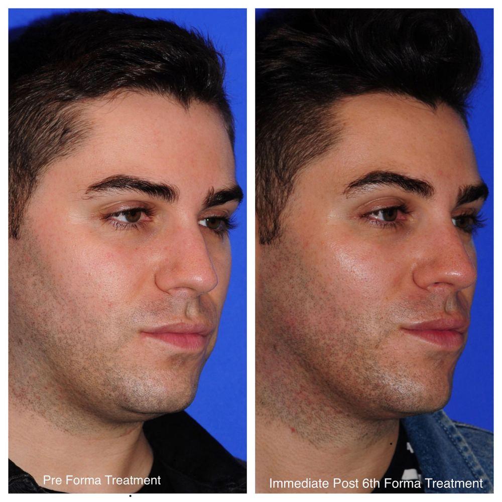 Marc Before & After Facial