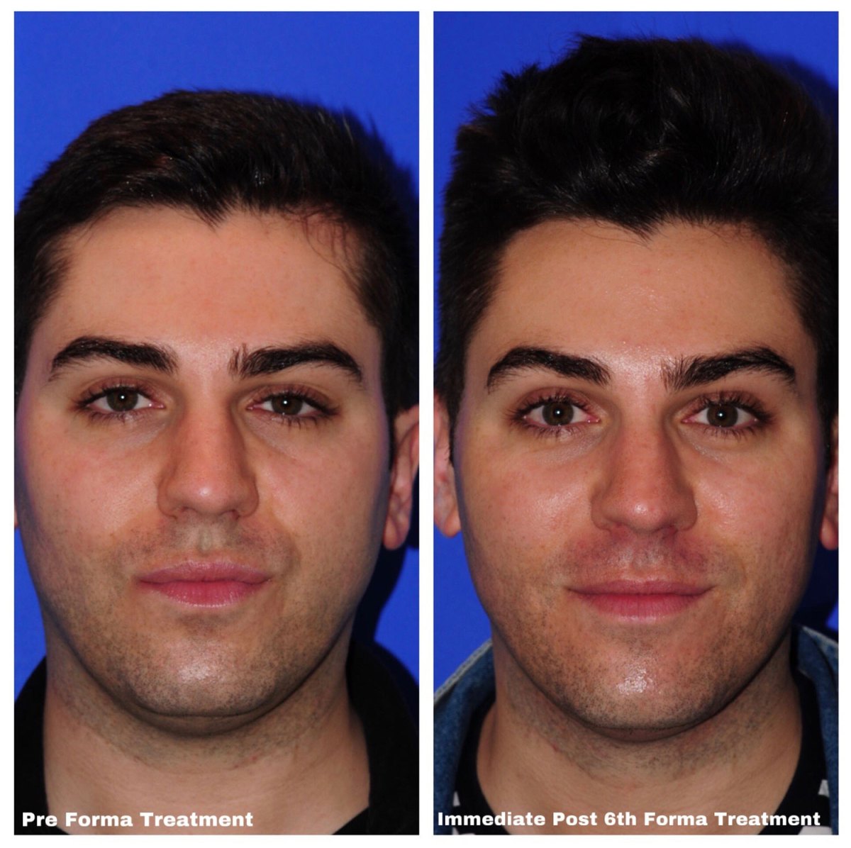 Forma Non-Invasive Face-Lift: Review | Us Weekly