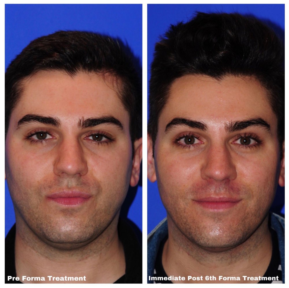 Marc Before & After Facial