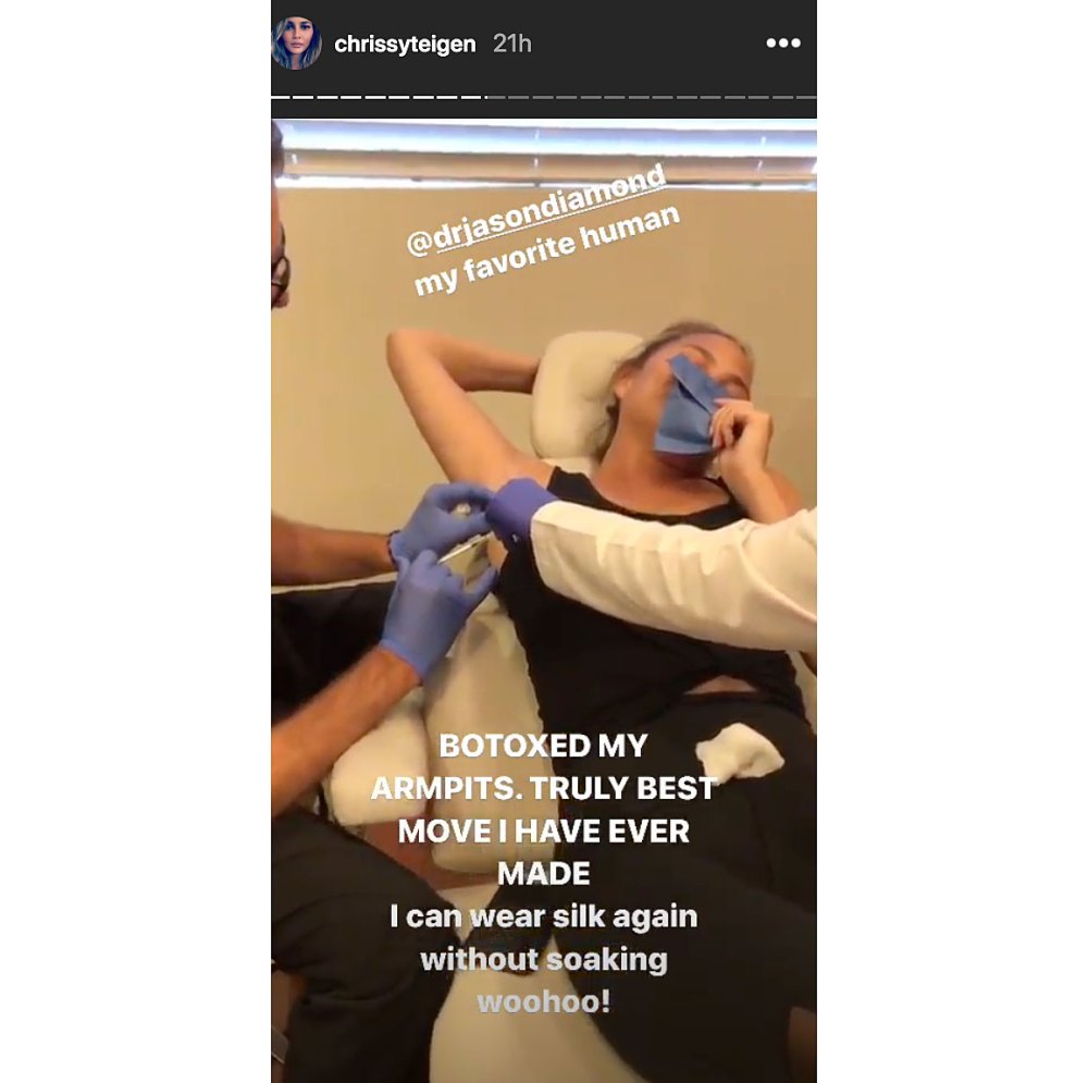 Chrissy Teigen Botoxes Armpit Instagram Story