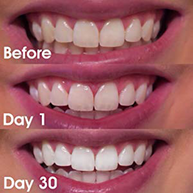 teeth whitener