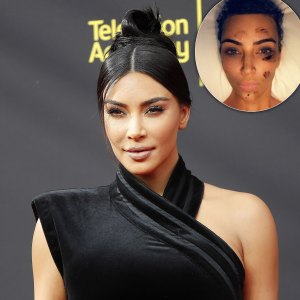Kim Kardashian Gets Candid About Psoriasis, Diet Changes