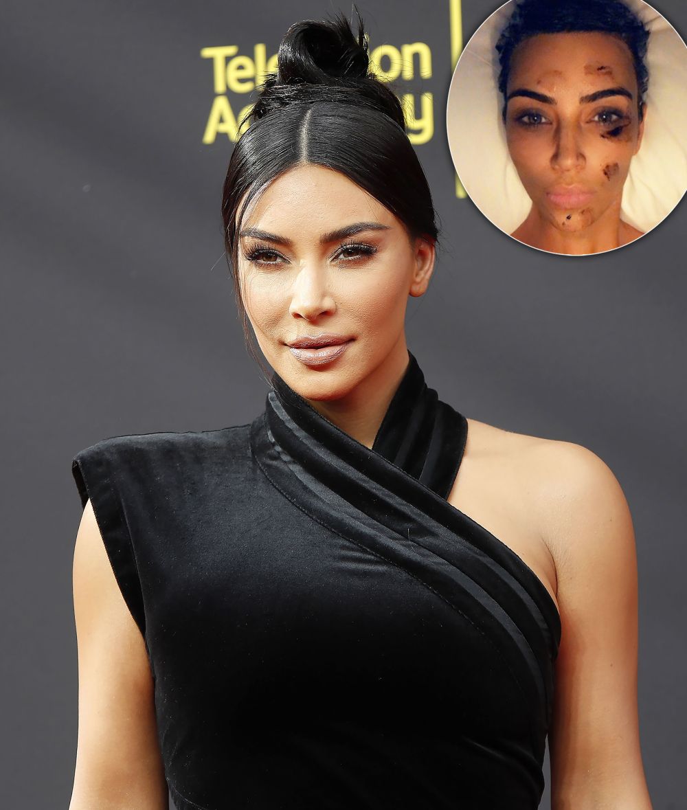 Kim Kardashian Gets Candid About Psoriasis, Diet Changes