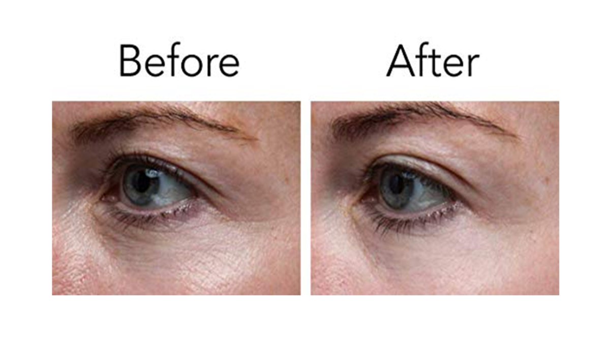Pronexa Lavish Eyes Anti-Aging Eye Serum Before After