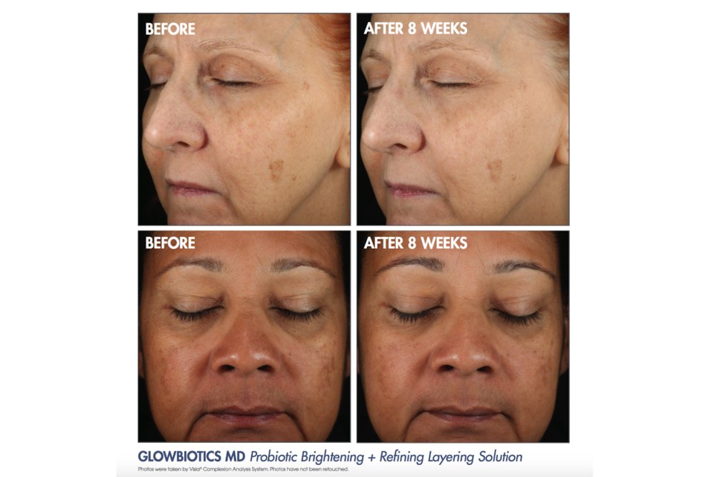 Glowbiotics MD Probiotic Before and After