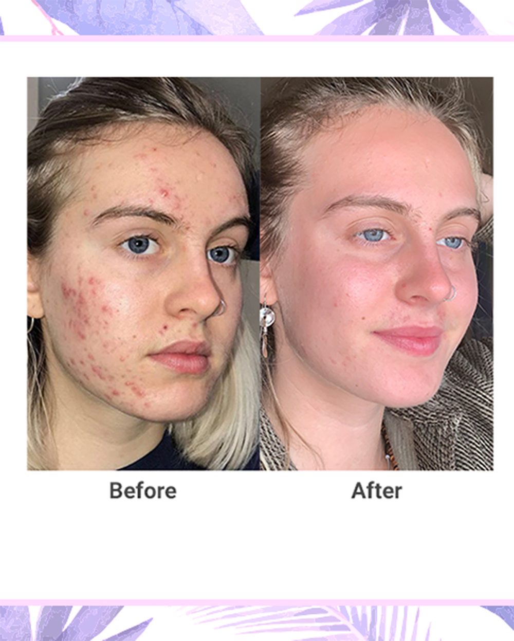 NxN Acne Treatment 4-Step Clear Skin System