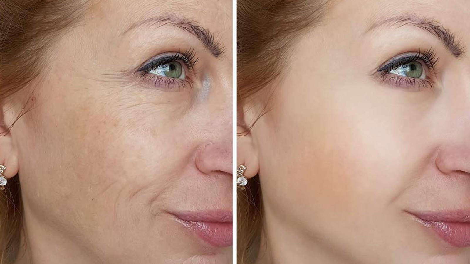 rosehip oil before and after