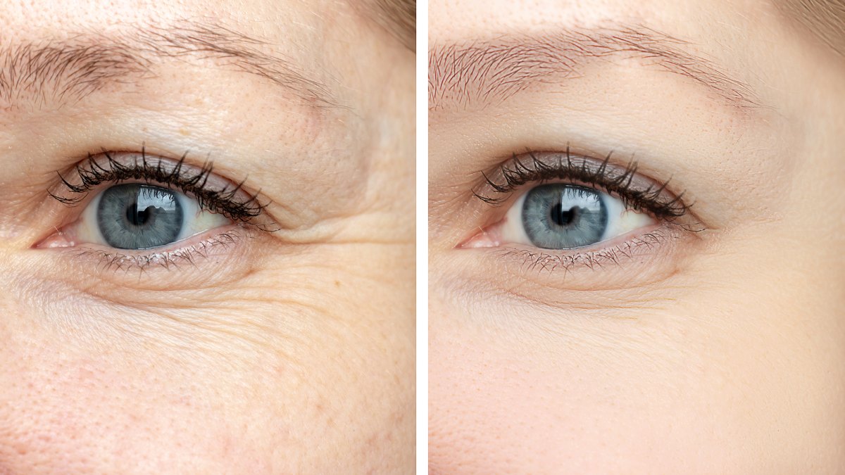 eye-tightener