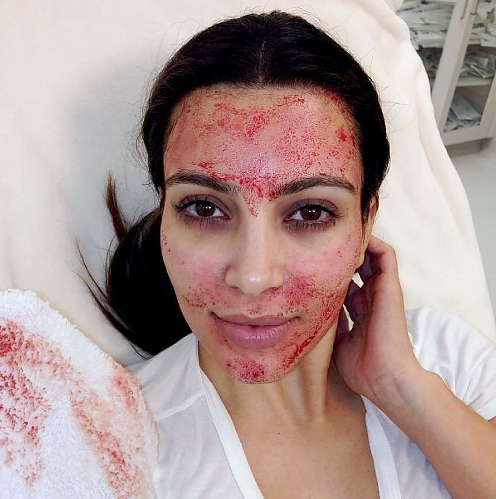 Kim Kardashian Vampire Facial Lawsuit