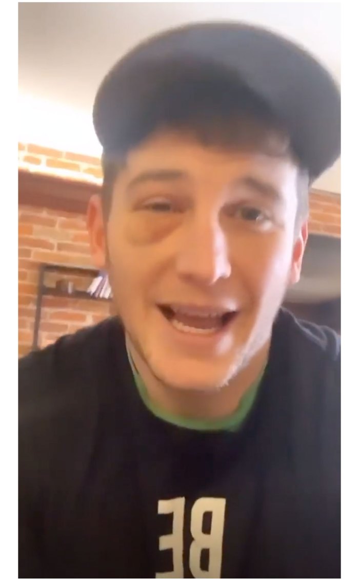 Blake Horstmann Punched In Face Black Eye Instagram
