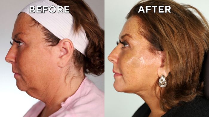 Abby Lee Miller Reveals Facelift Results See Before After Photos