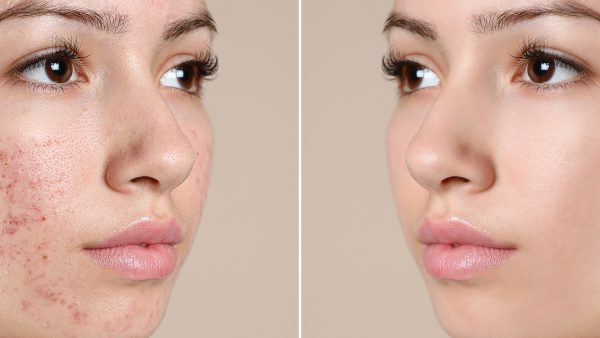 before-after-skin