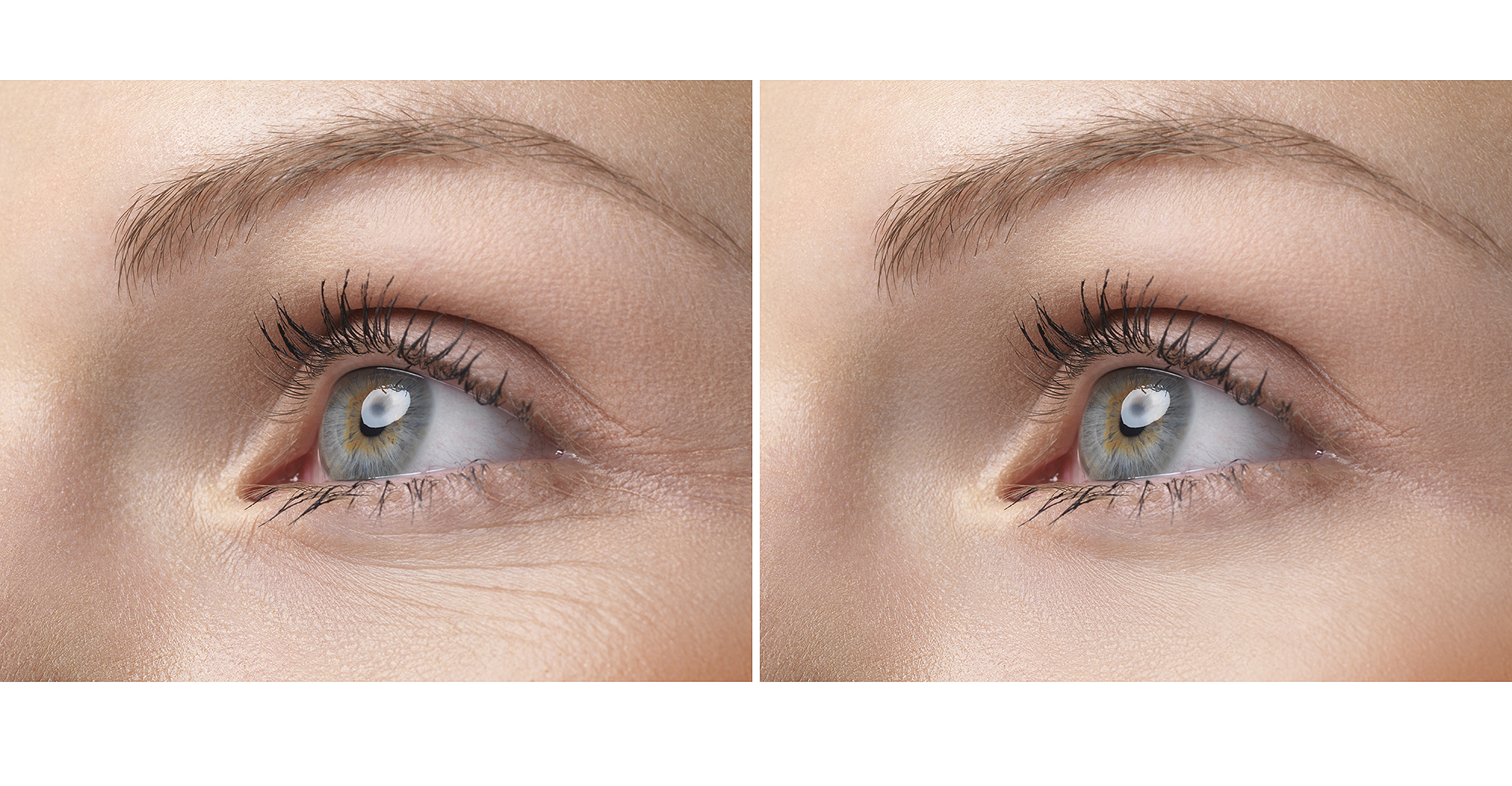 eye-wrinkle-before-after