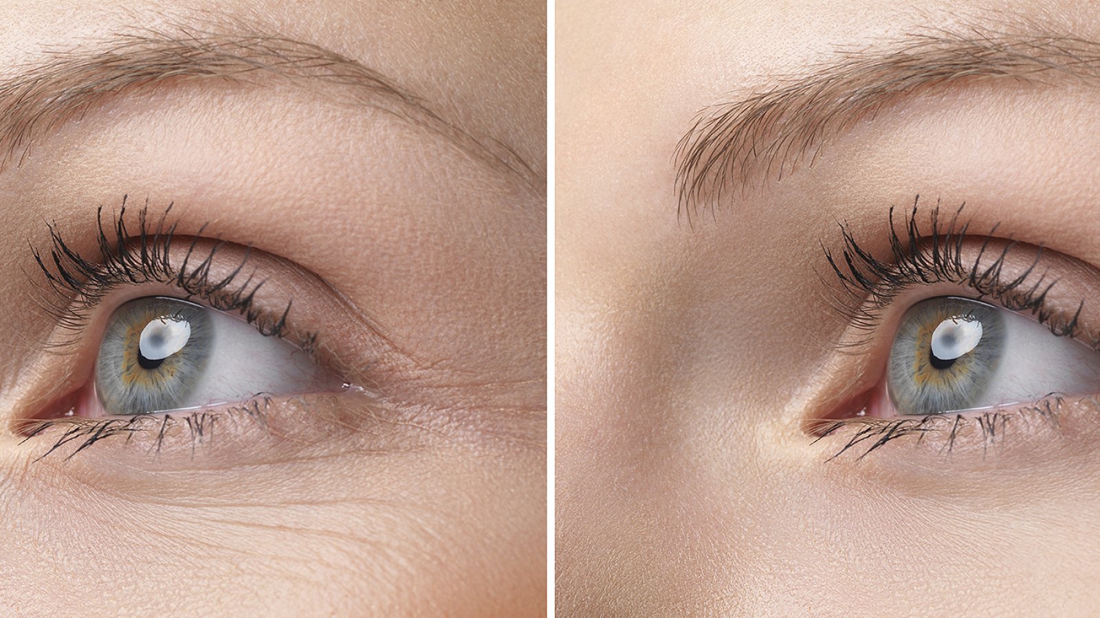 eye-wrinkle-before-after