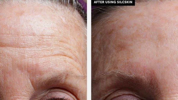 silc-skin-before-after