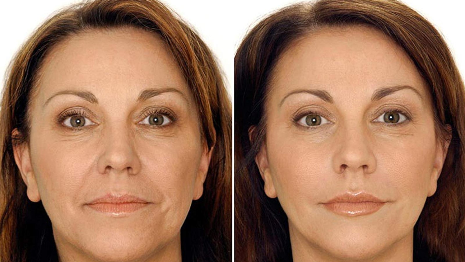 H-Art V-Shape Lifting Face Mask (5 Count) before and after