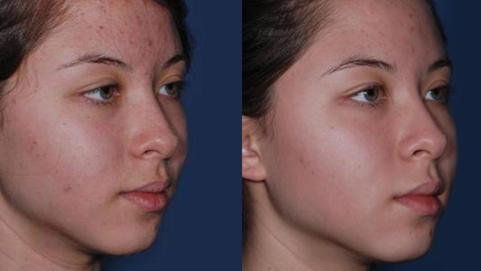Obagi Acne Treatment