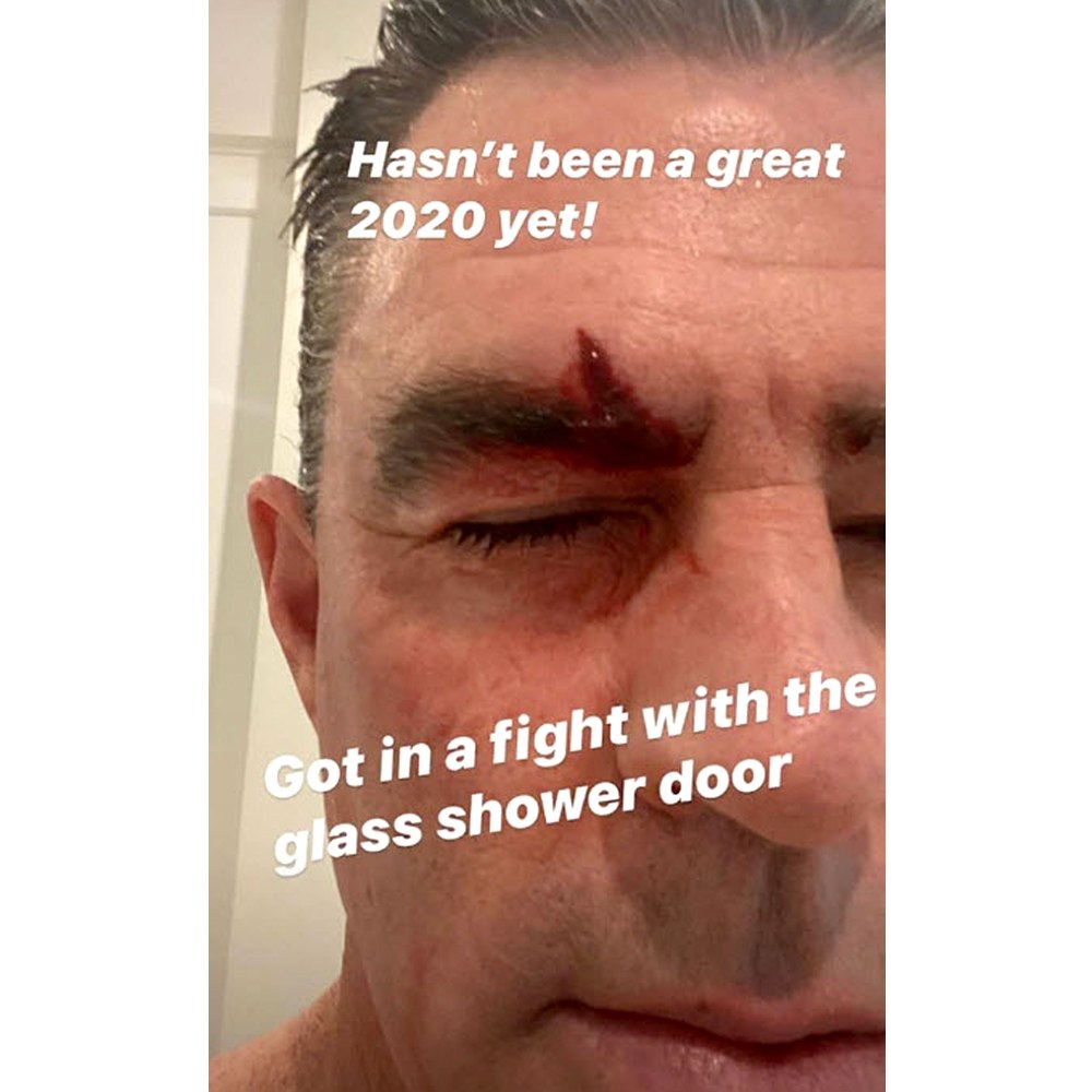Jim Edmonds Gets Stitches After Losing Fight With His Shower Door