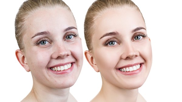before-after-skin