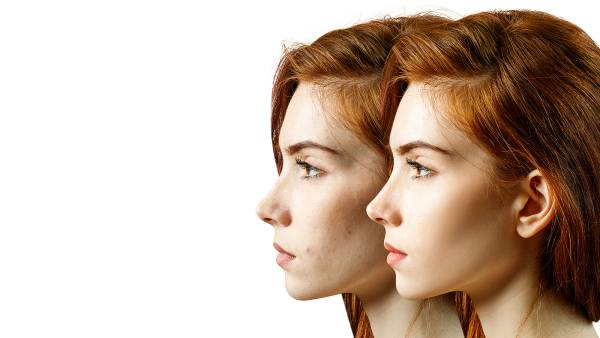 before-after-skin