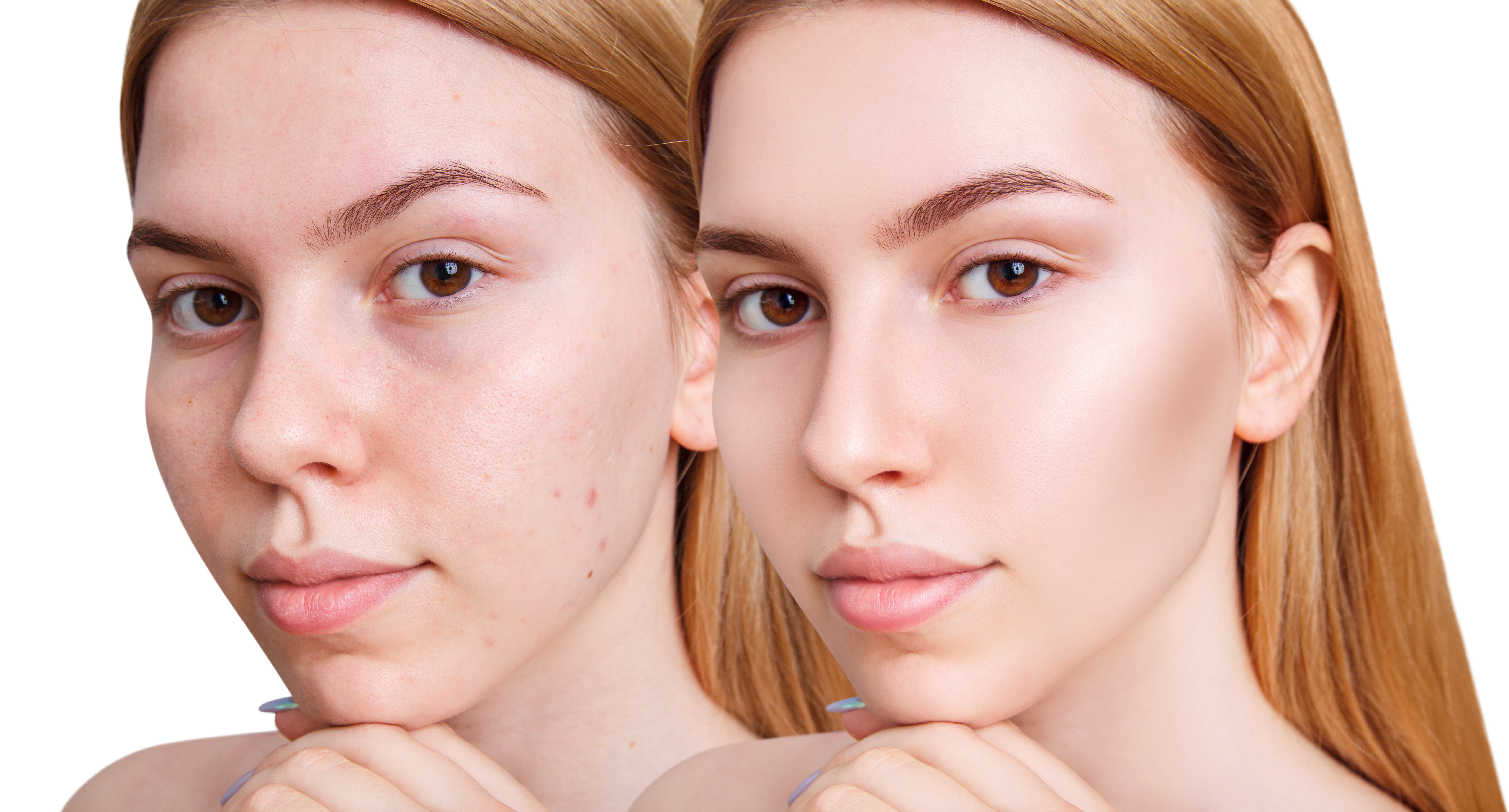 before and after acne streatment