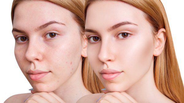 before and after acne streatment