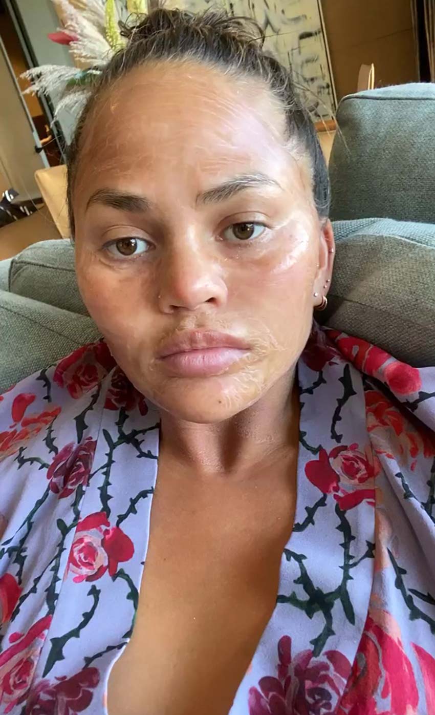 LOL! Chrissy Teigen Tests a Face-Freezing Skincare Treatment