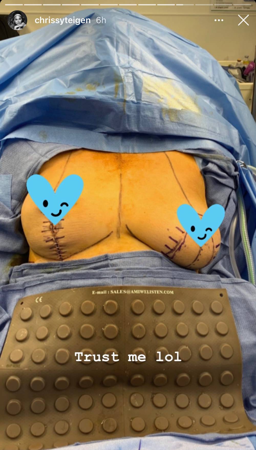 Chrissy Teigen Shares Pic of Breast Implant Removal Surgery and Scars