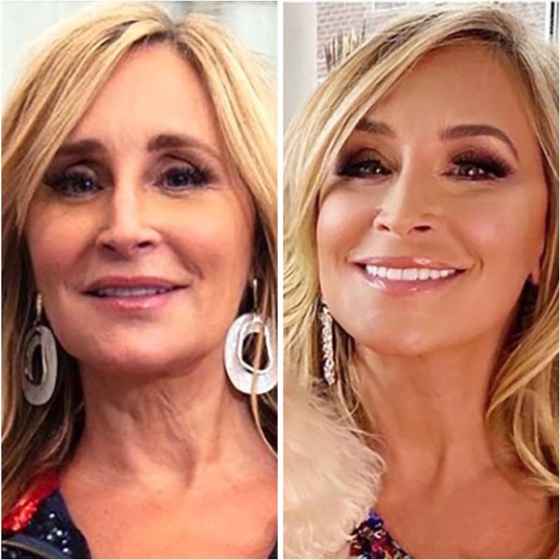 Sonja Morgan plastic surger before and after