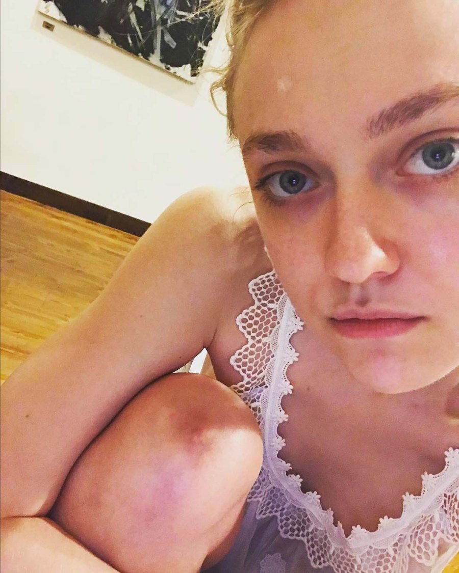 Stars Who’ve Normalized Adult Acne Through the Years: Pics