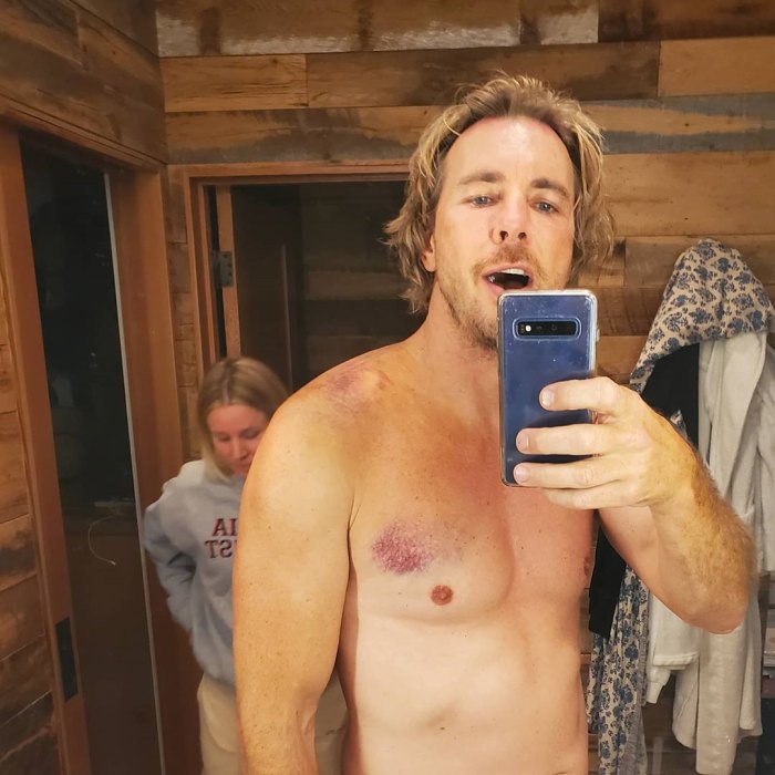 Dax Shepard Needs Surgery After Breaking 4 Ribs in Motorcycle Accident