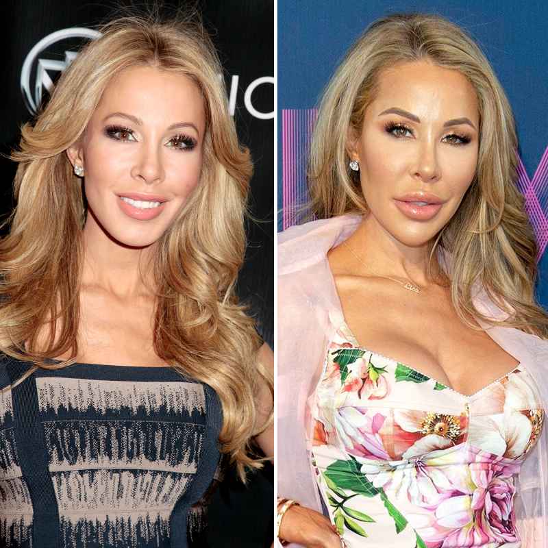 Lisa Hochstein before and after plastic surgery