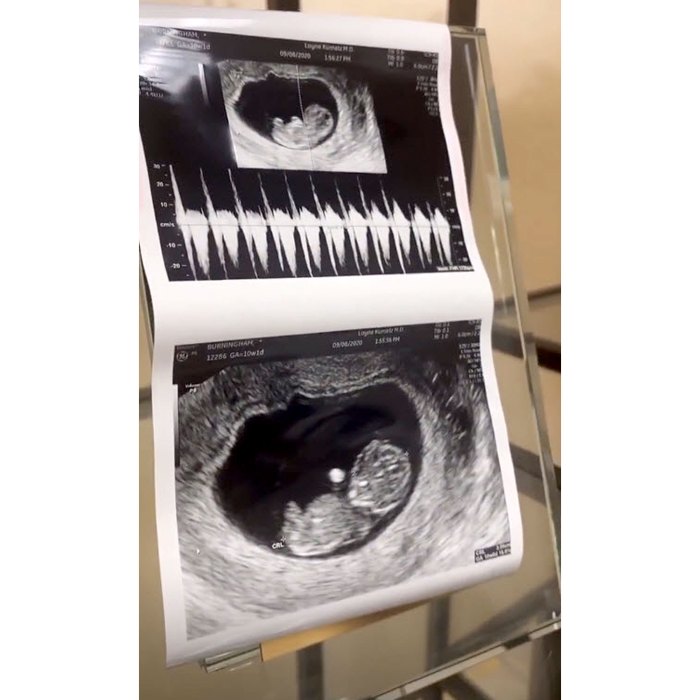 Pregnant Lala Kent Randall Emmett Show Ultrasound Pic Ahead 1st Child Together