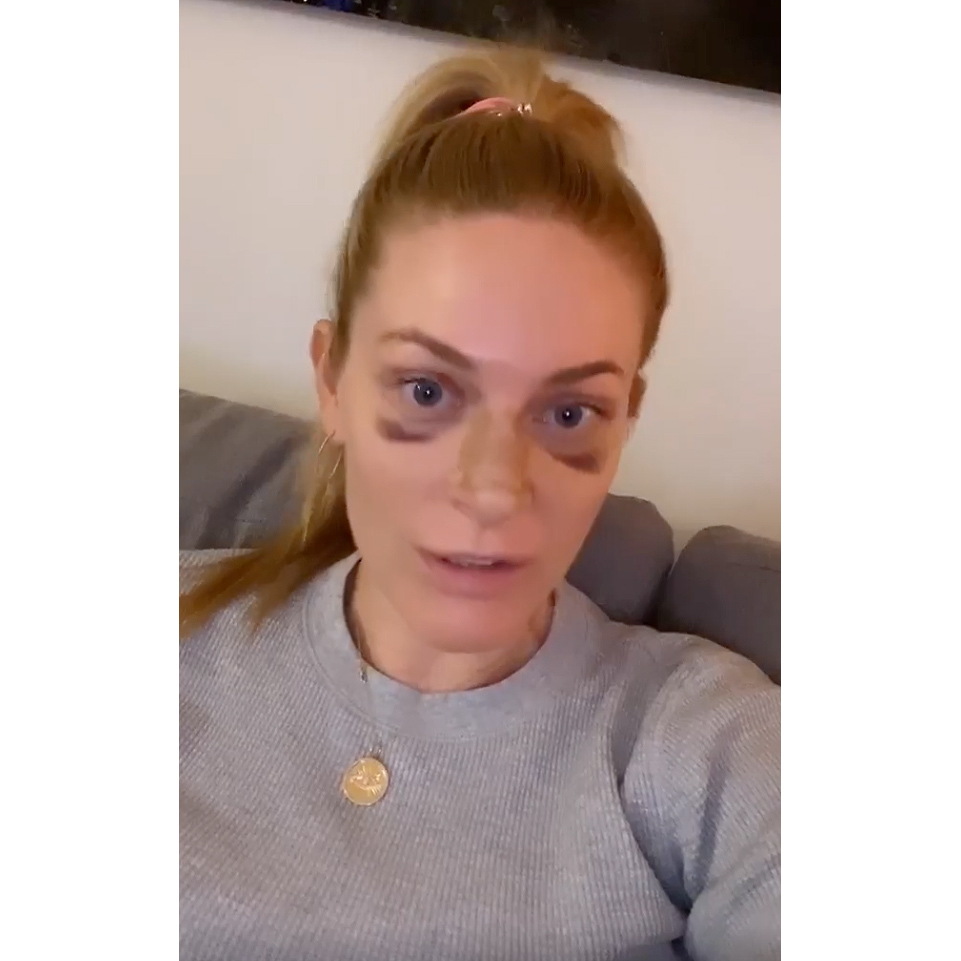 RHONY Leah McSweeney Reveals She Got a Nose Job
