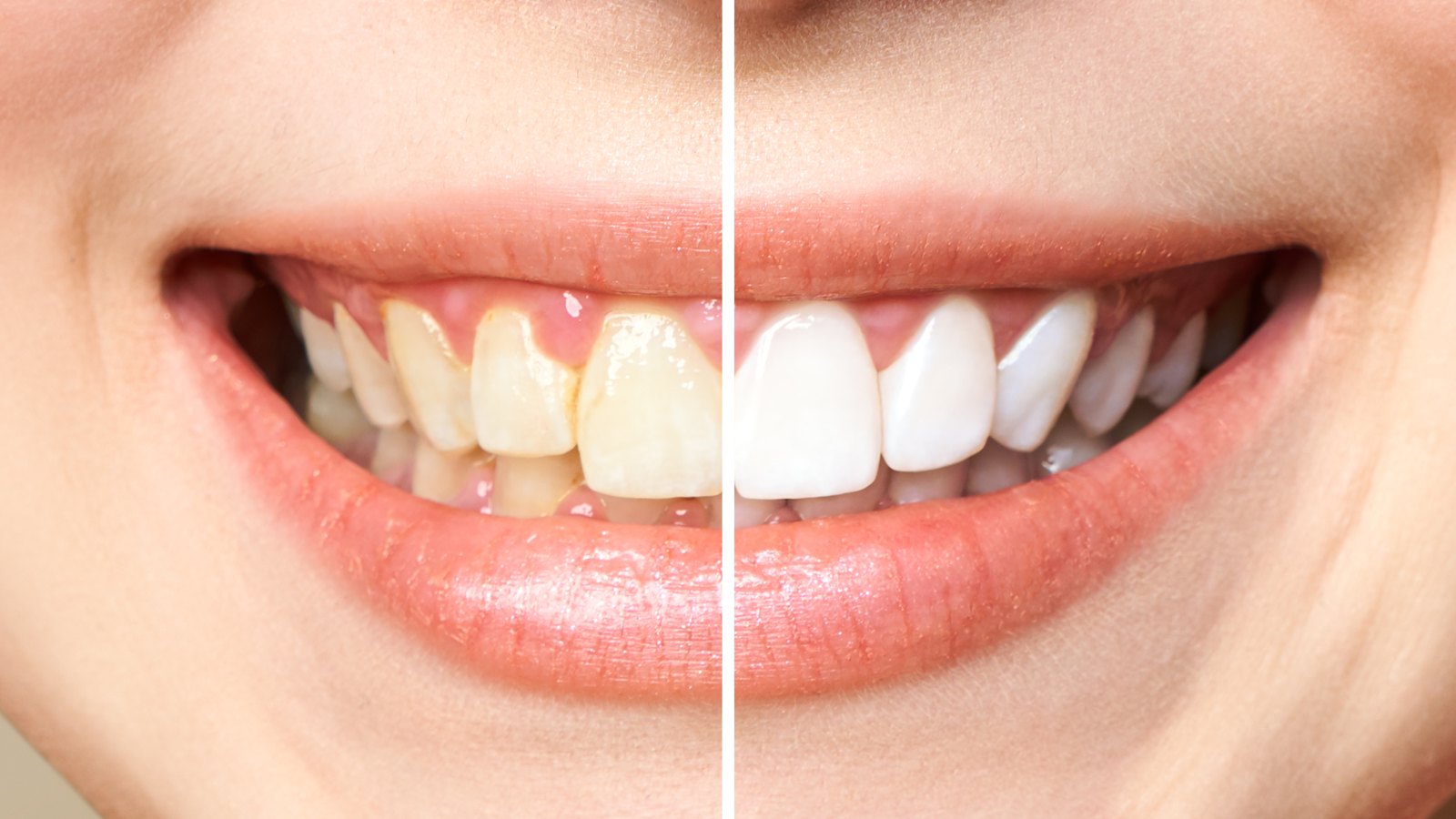 before-after-teeth-whitening-stock-photo