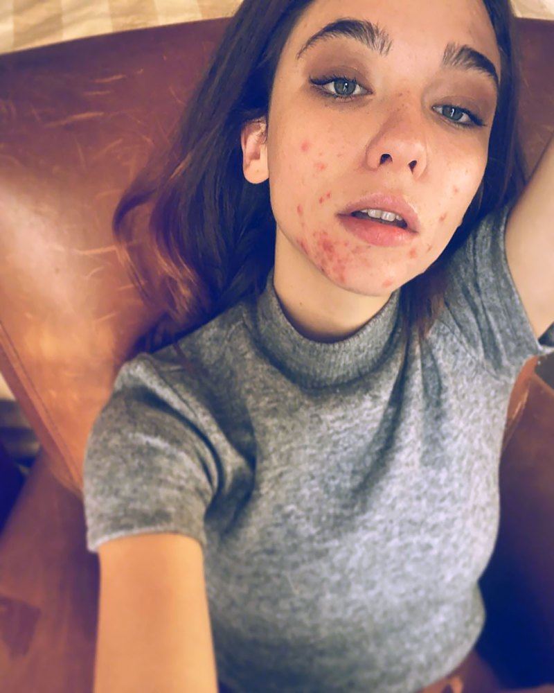 The Undoing's Matilda De Angelis Shares a Pic of Her 'Face Eaten By Acne'