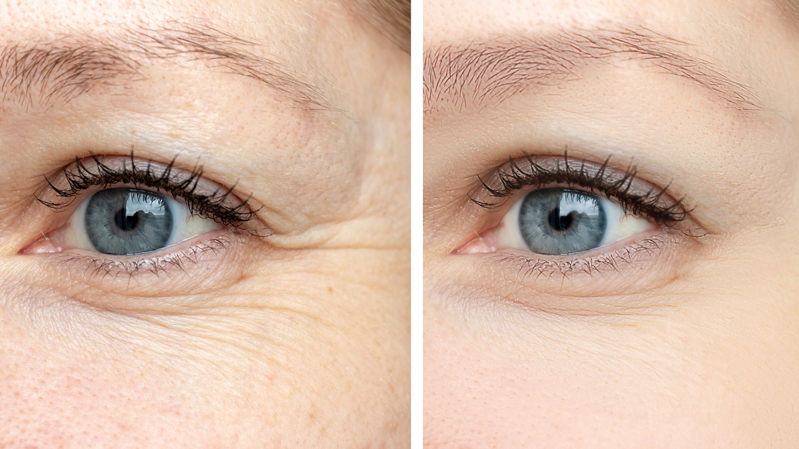 before-after-eye-wrinkles-serum-cream