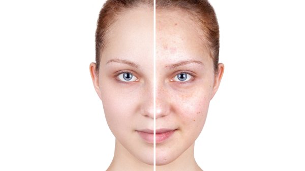 Before-and-After-Skincare-Stock-Photo